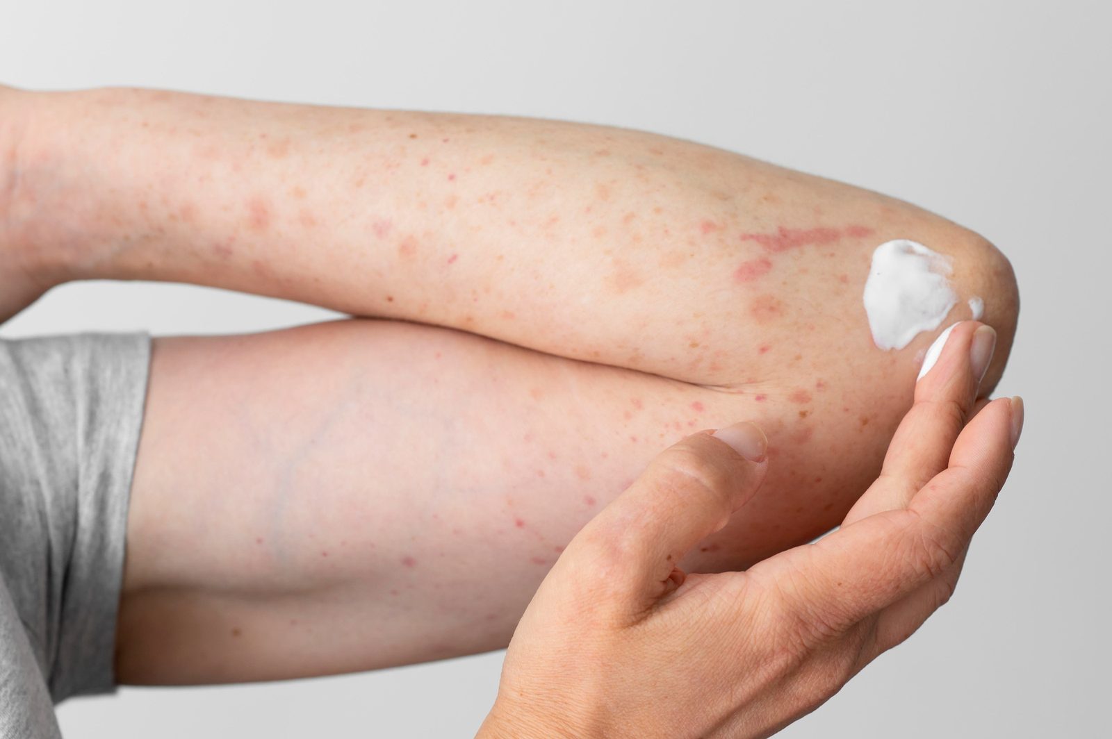 Arm mit Neurodermitis-Ausschlag, Creme wird an der Ellenbeuge aufgetragen