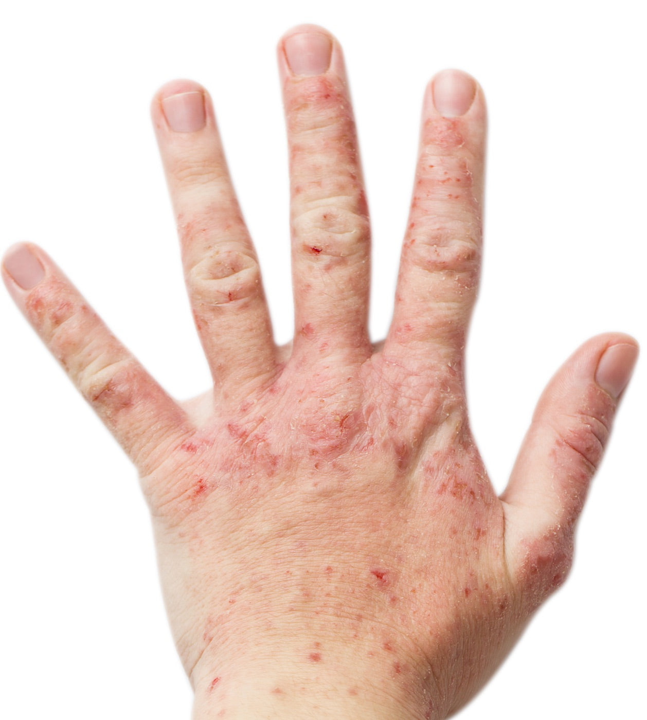 Hand mit Neurodermitis vor der Anwendung